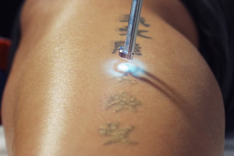 Laser removal procedure on tattooed skin, showing a focused beam targeting dark ink with a glowing effect.