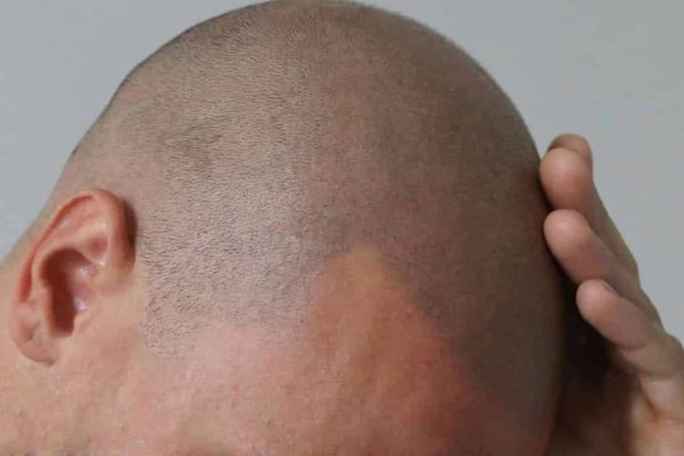 Man's scalp with new hair growth, hand touching head, close-up view.